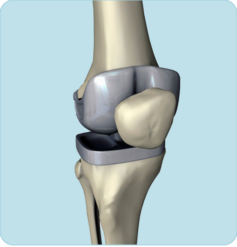 Cirugía de rodilla SAP Fonasa